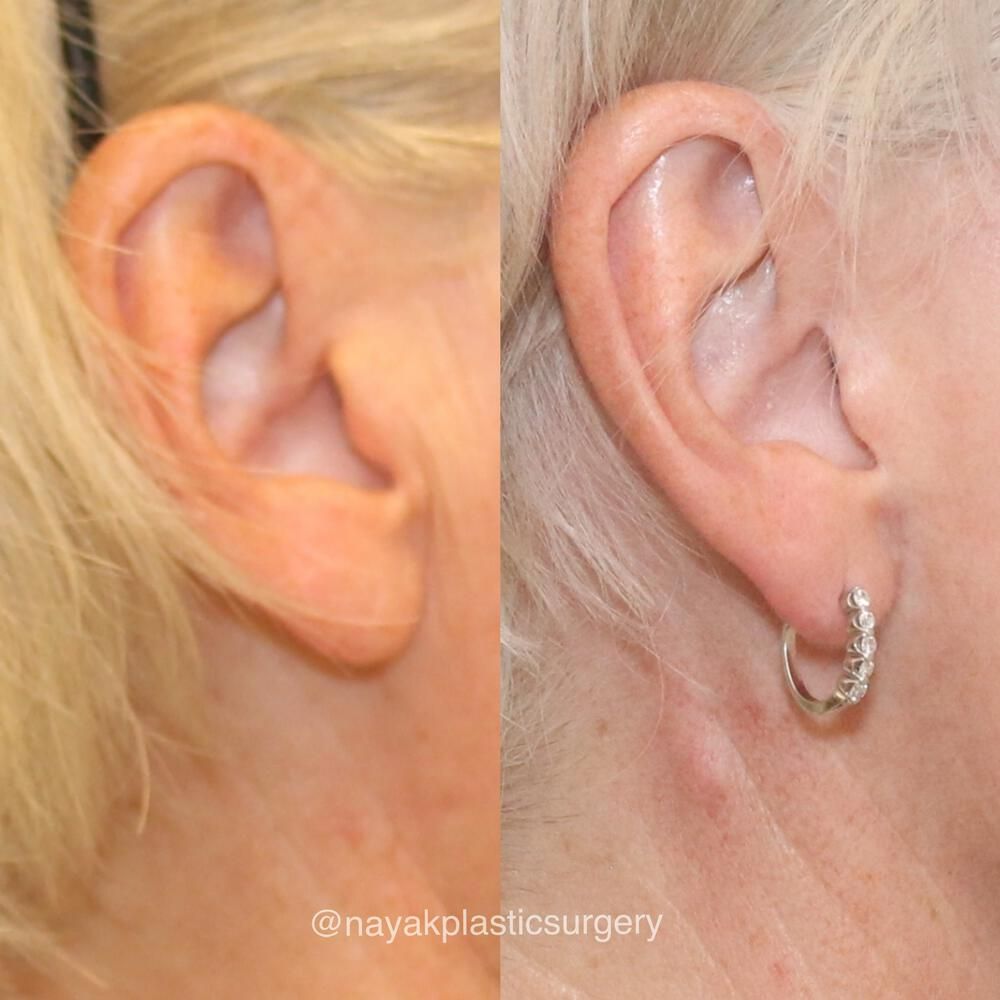Ear Surgery Before & After