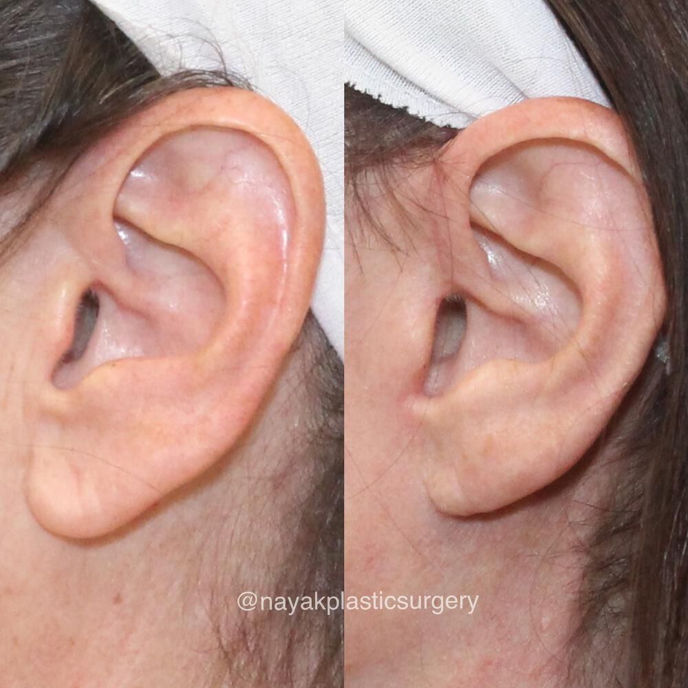 Ear Surgery Before & After