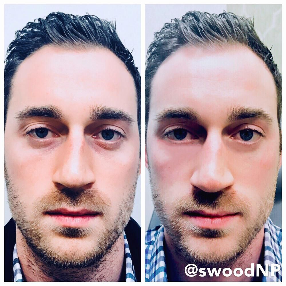 Tear Trough Filler Before & After