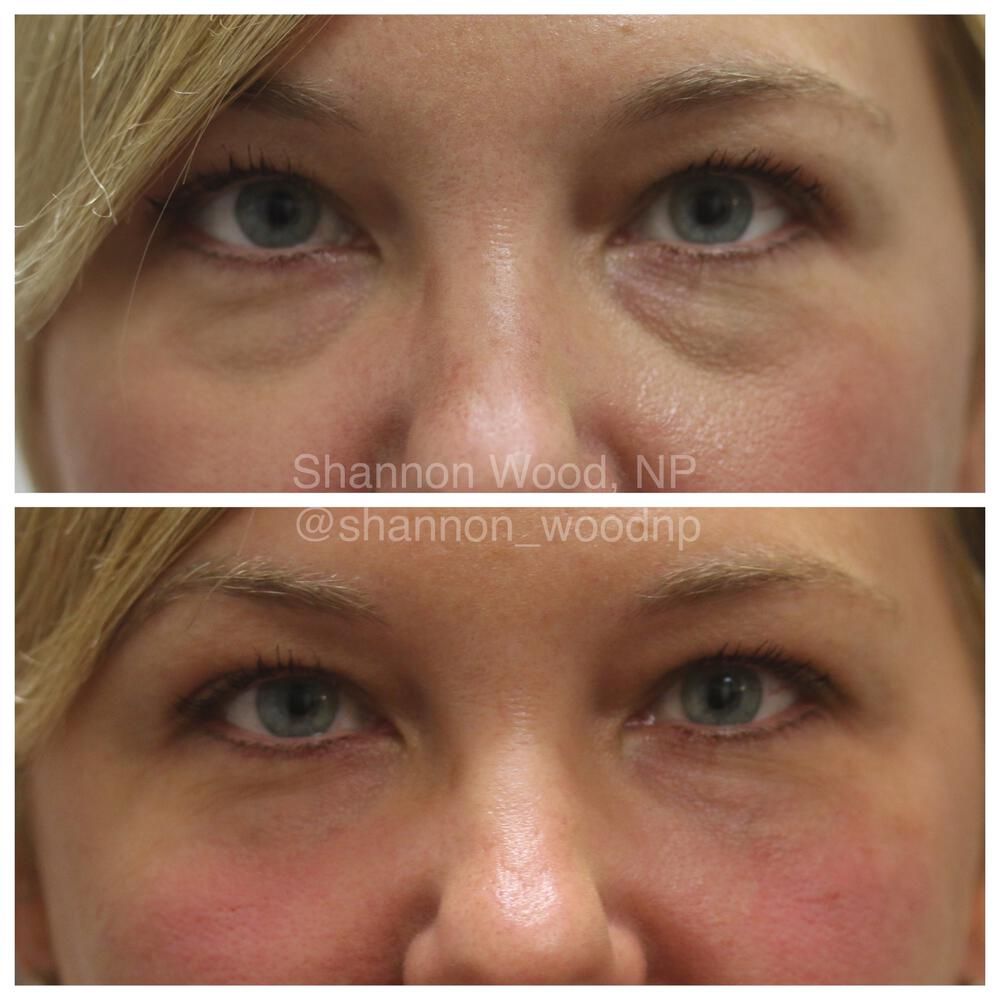 Tear Trough Filler Before & After