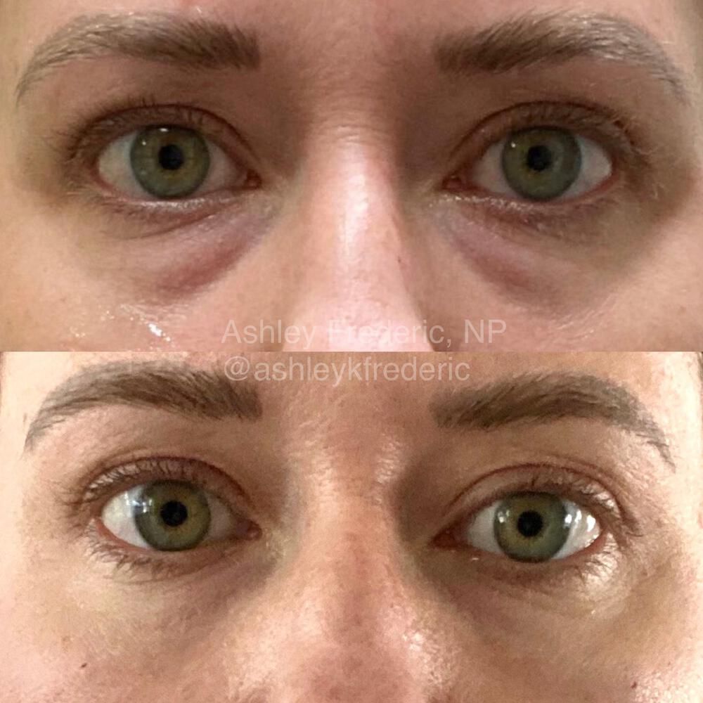 Tear Trough Filler Before & After