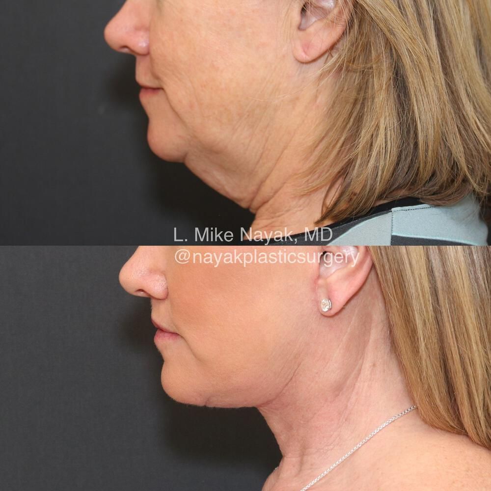 Lip Lift Before & After