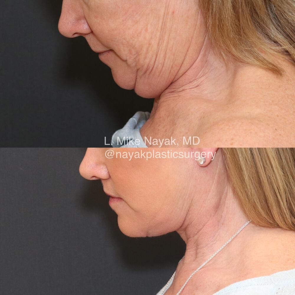 Lip Lift Before & After