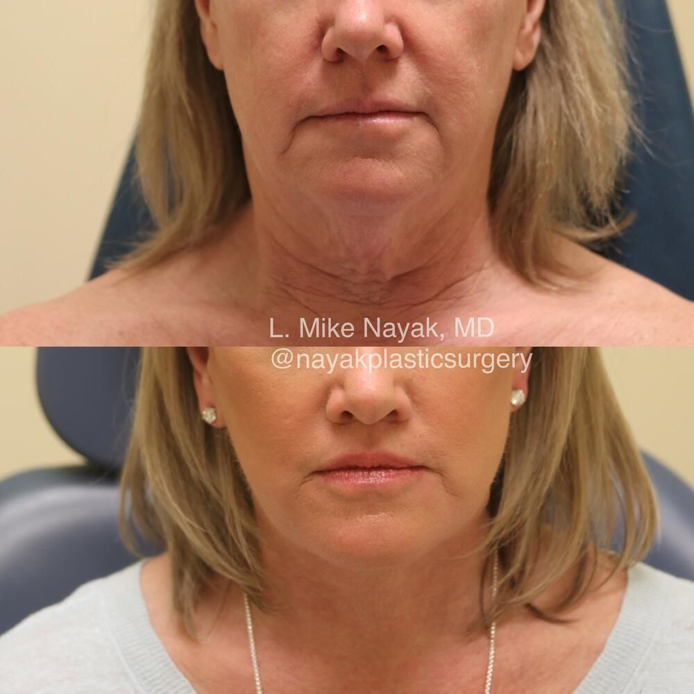 Lip Lift Before & After