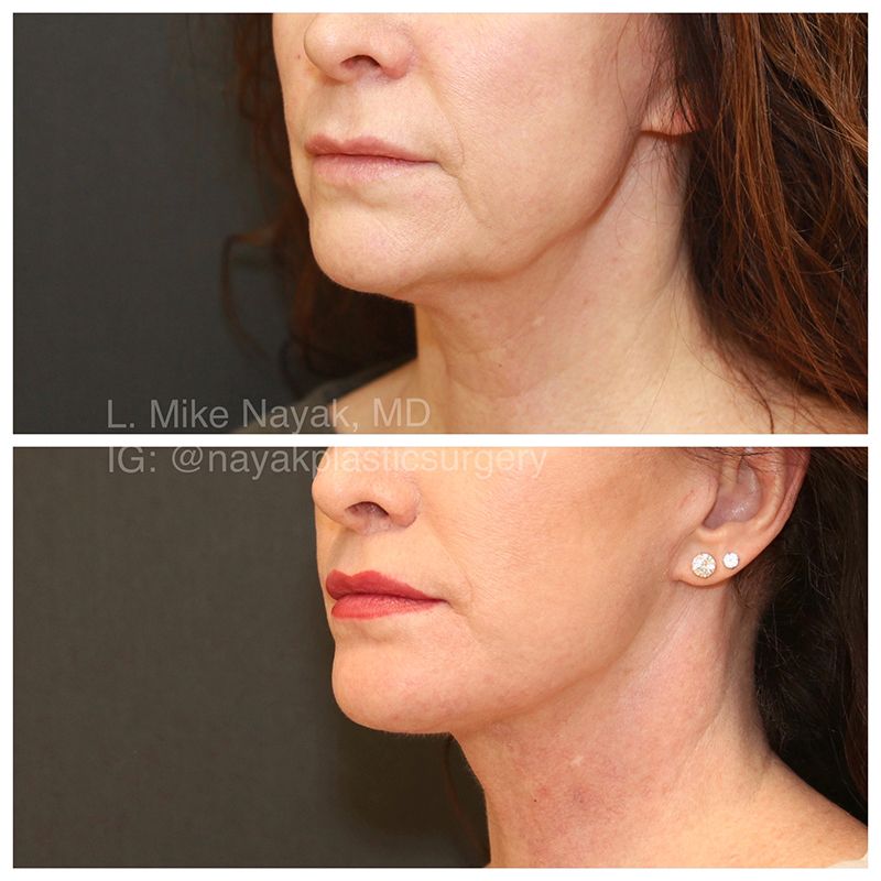 Lip Lift Before & After