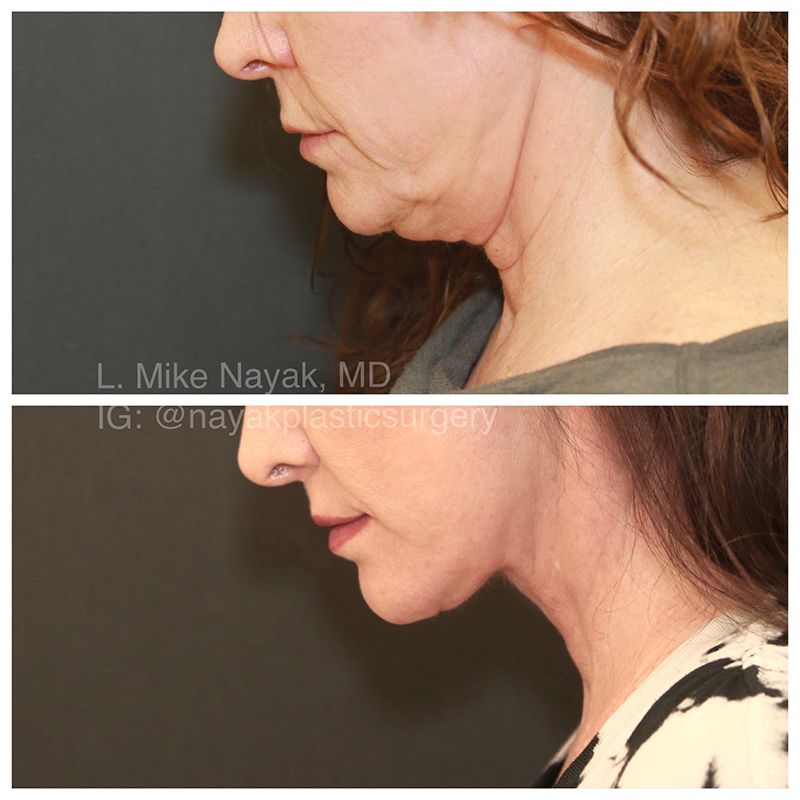 Lip Lift Before & After