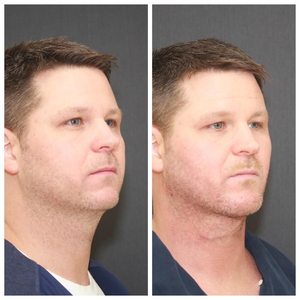 Deep Necklift Before & After