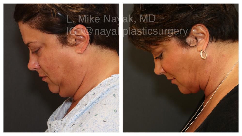 Deep Necklift Before & After
