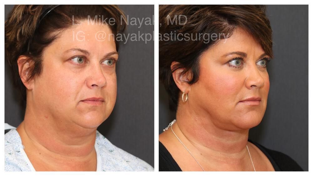 Deep Necklift Before & After