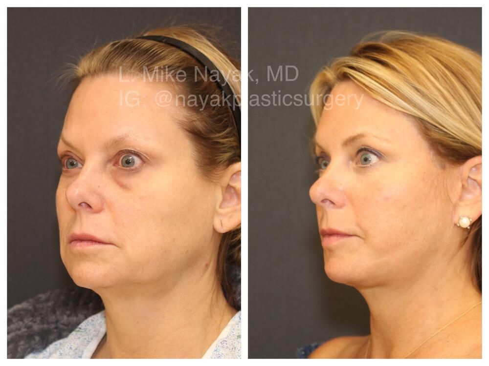 Deep Necklift Before & After