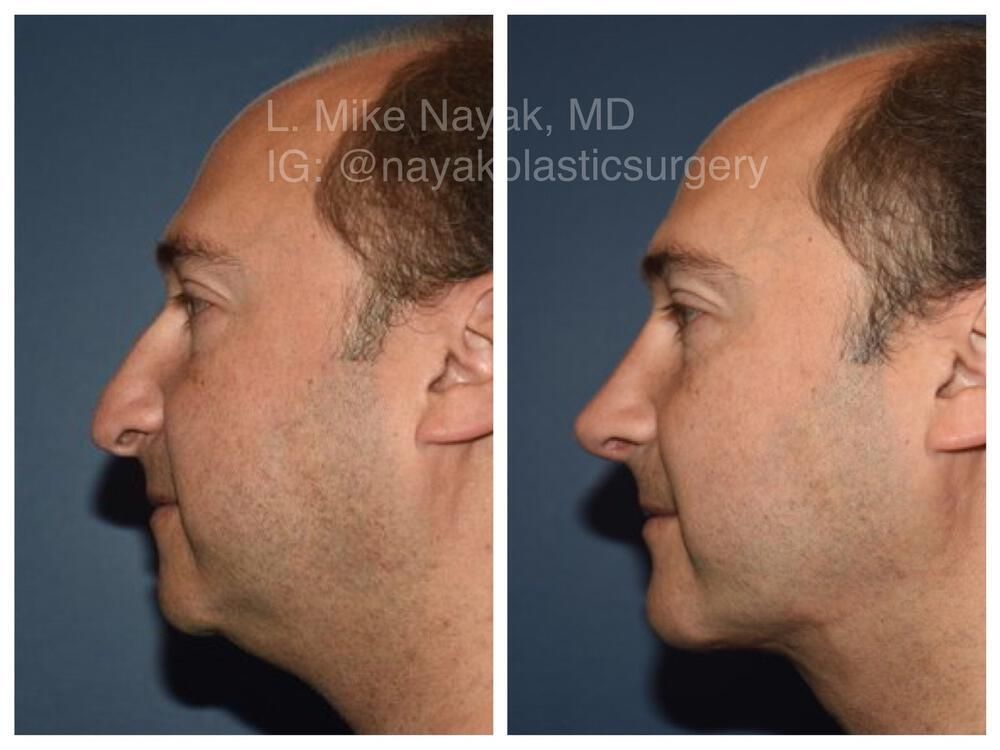 Deep Necklift Before & After