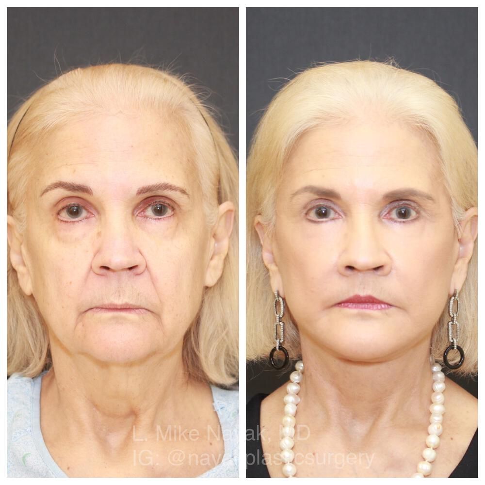 Deep Necklift Before & After
