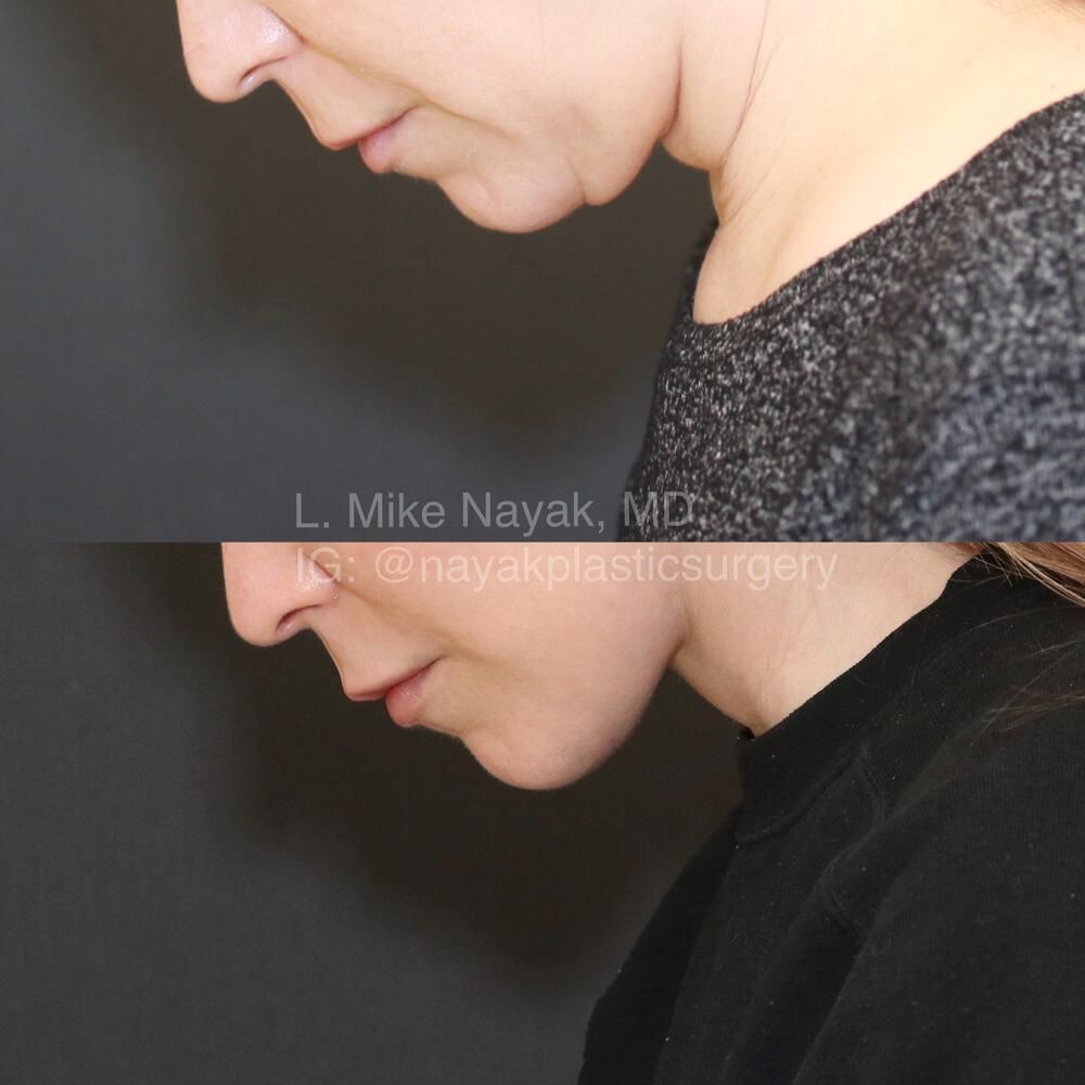 Deep Necklift Before & After