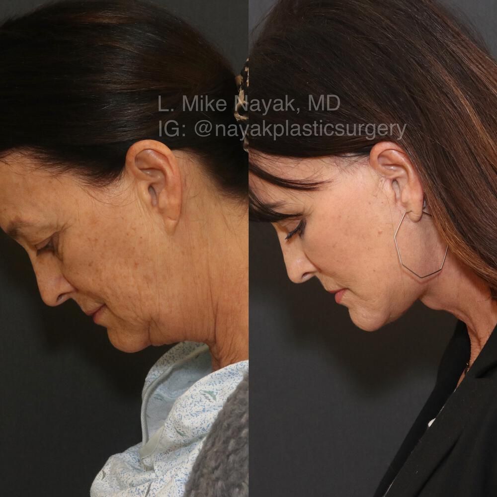Deep Necklift Before & After