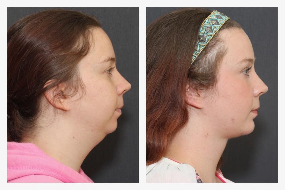 Deep Necklift Before & After