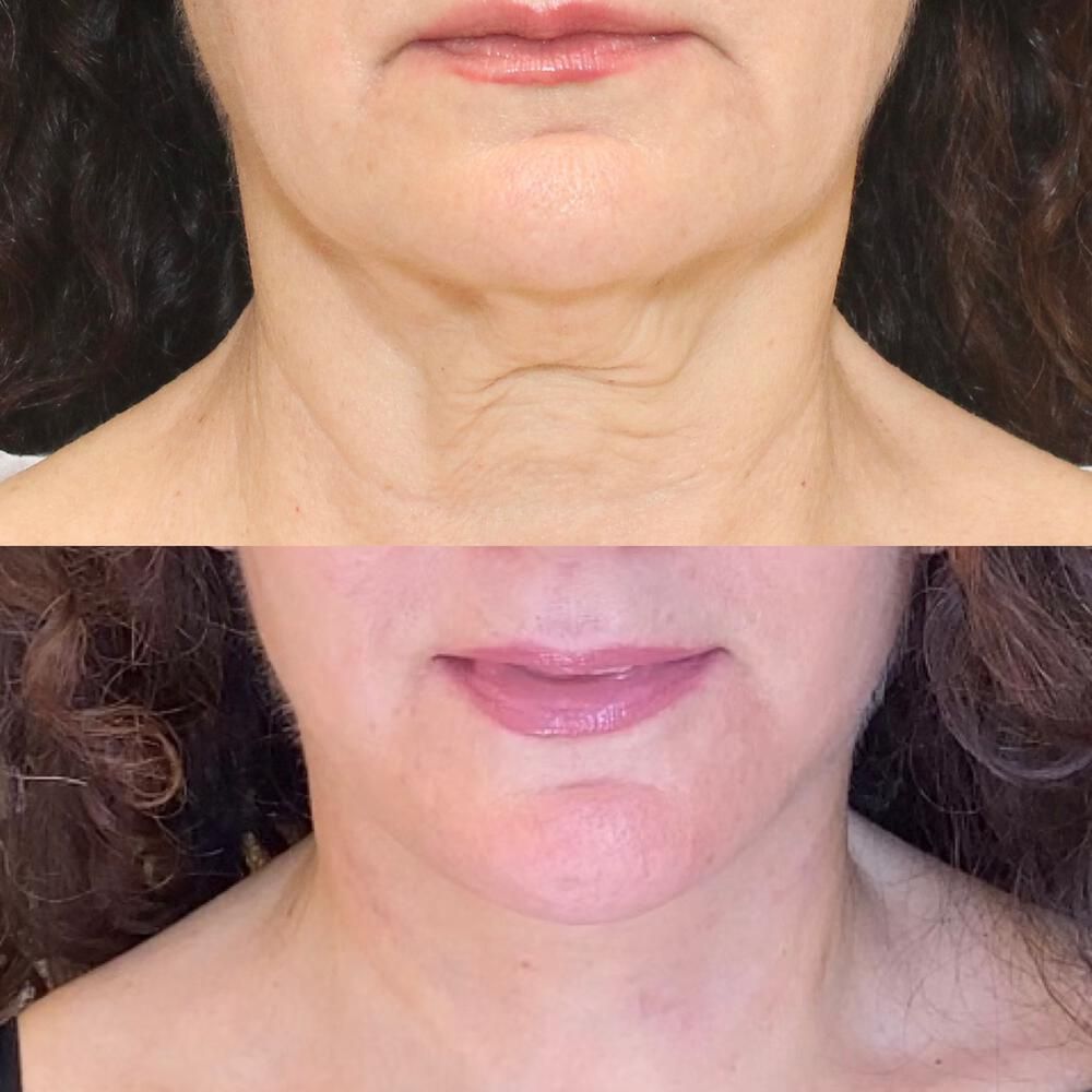 Deep Necklift Before & After