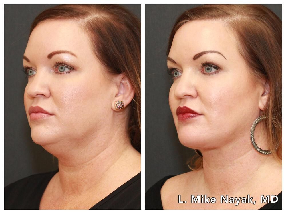 Deep Necklift Before & After