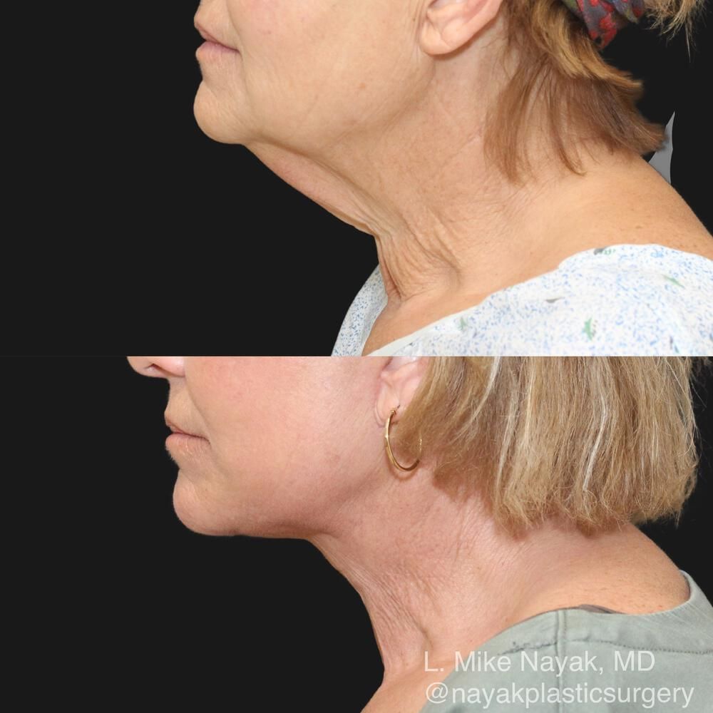 Deep Necklift Before & After