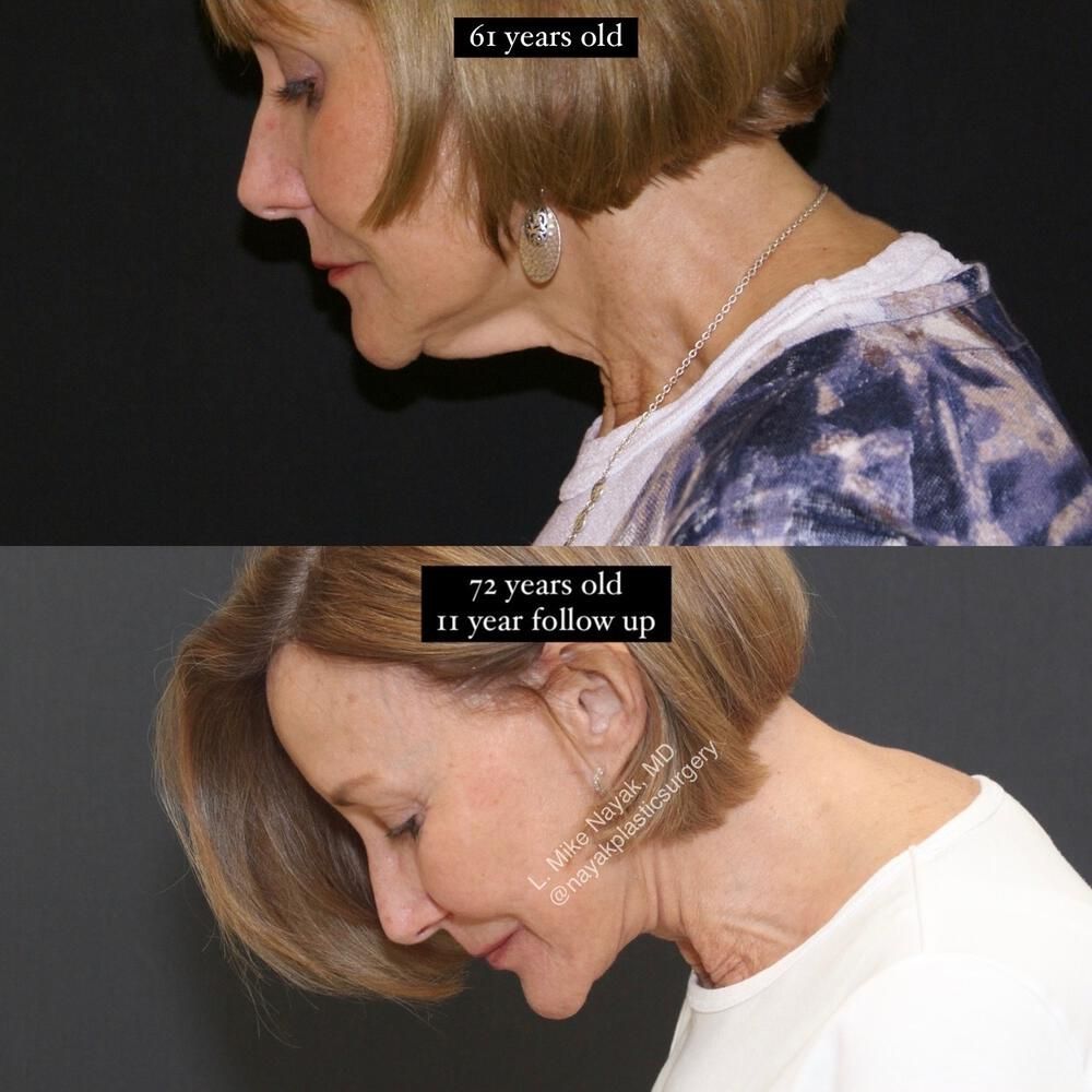 Deep Necklift Before & After