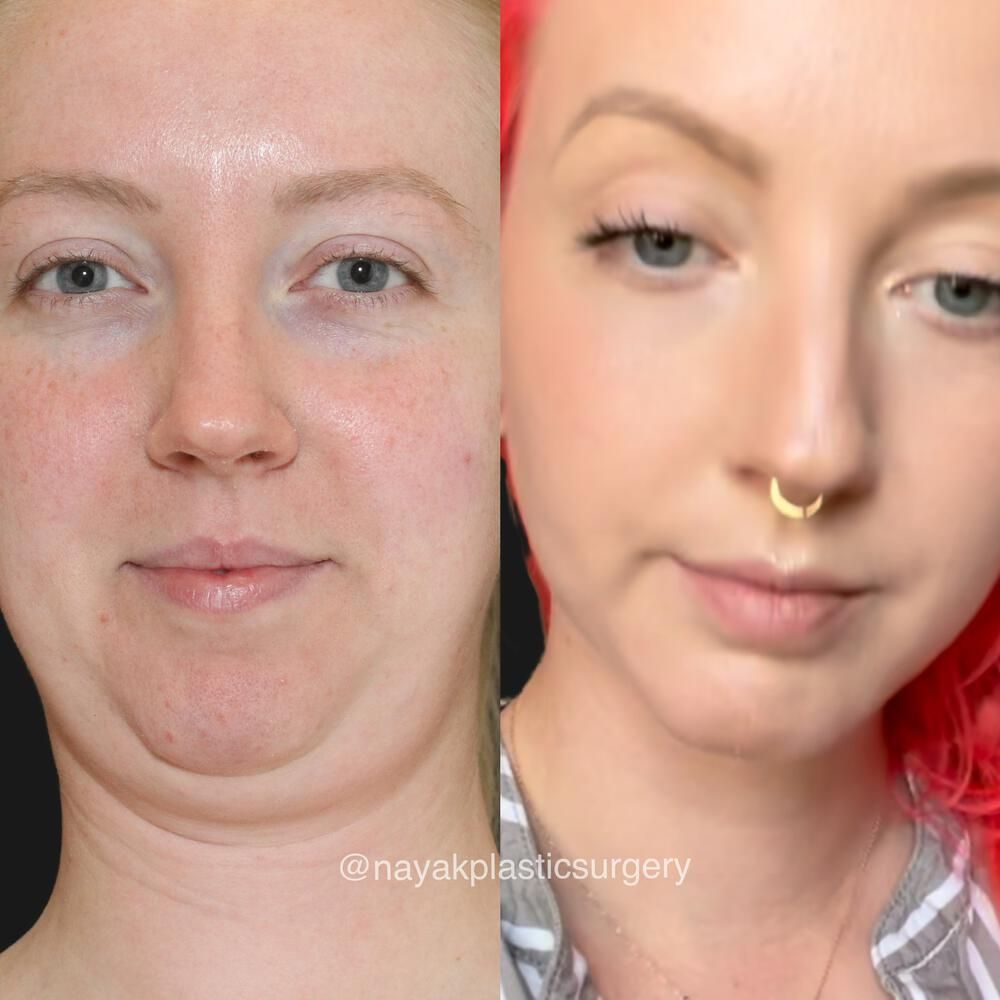 Deep Necklift Before & After