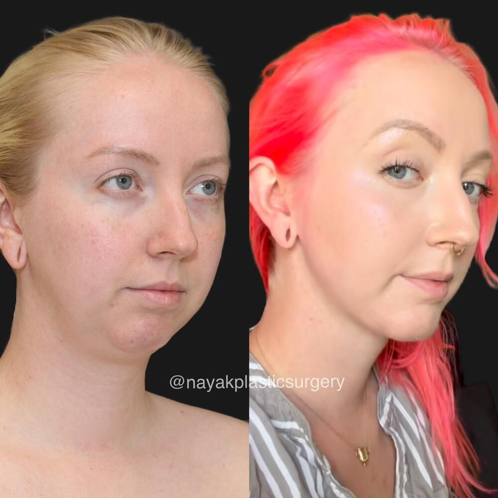 Deep Necklift Before & After