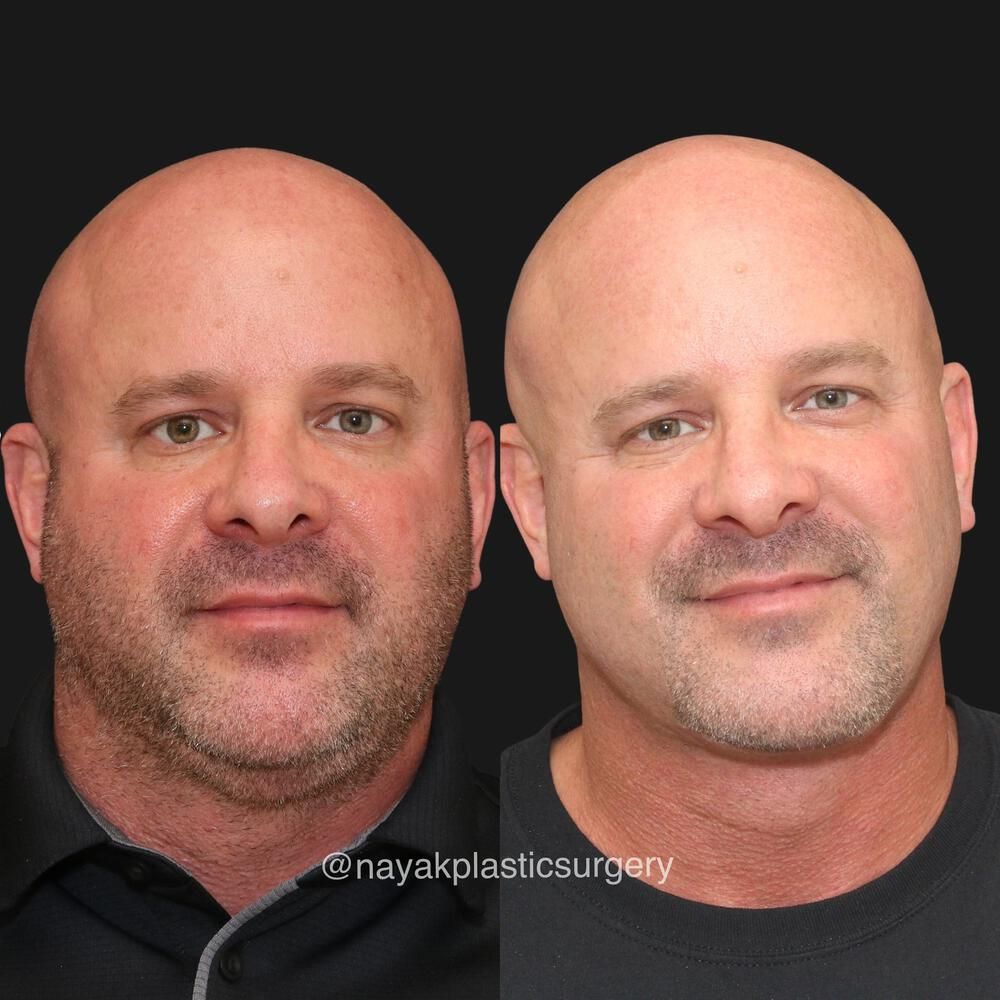 Deep Necklift Before & After