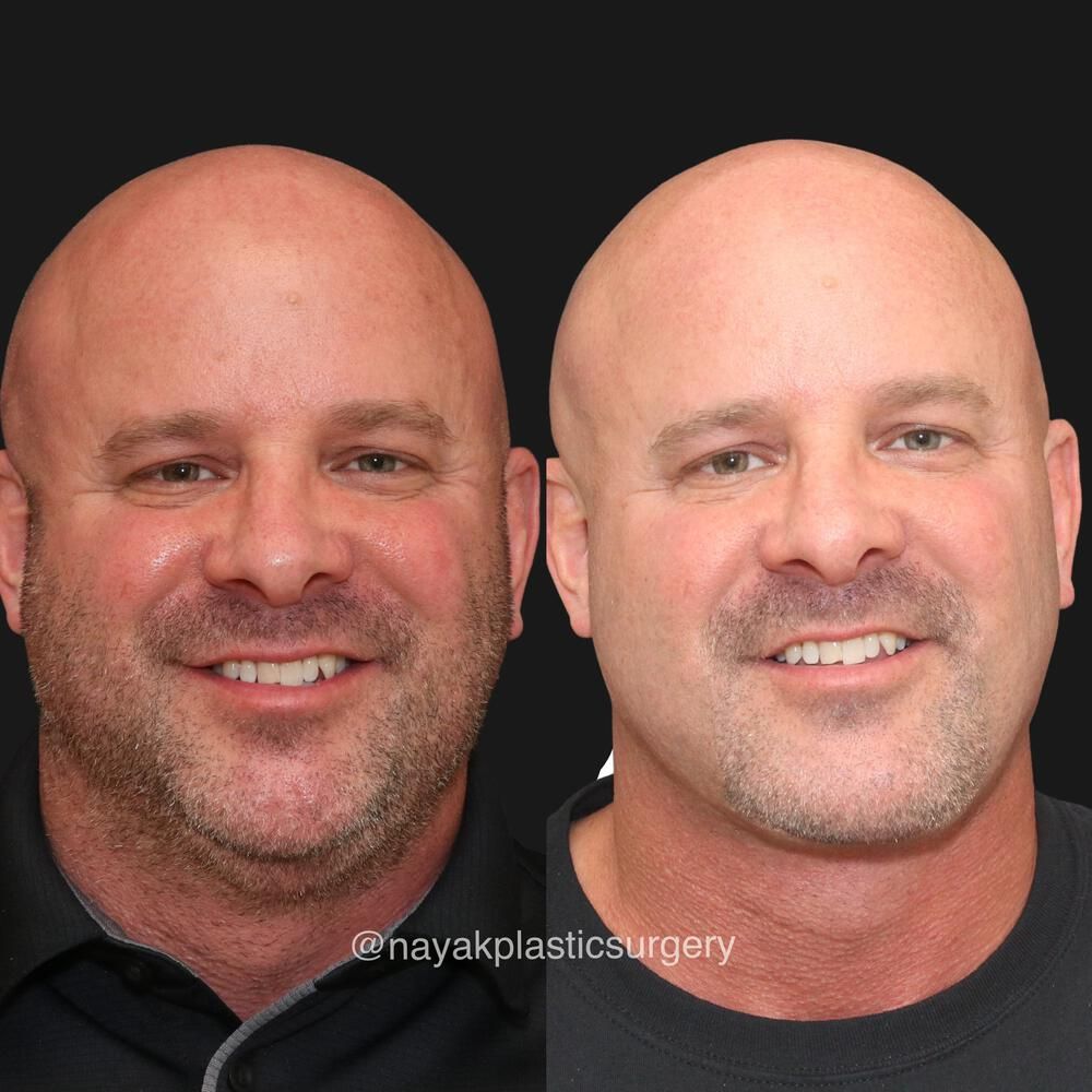 Deep Necklift Before & After