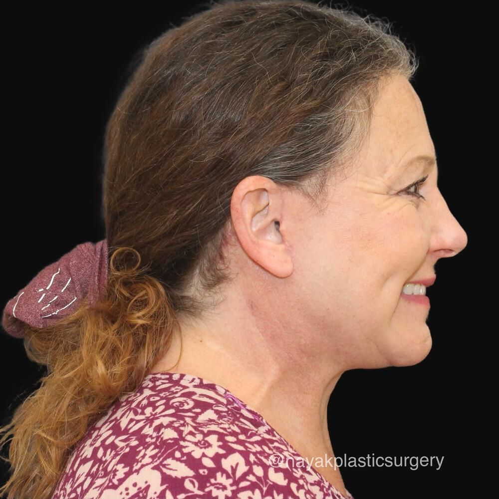 Deep Necklift Before & After