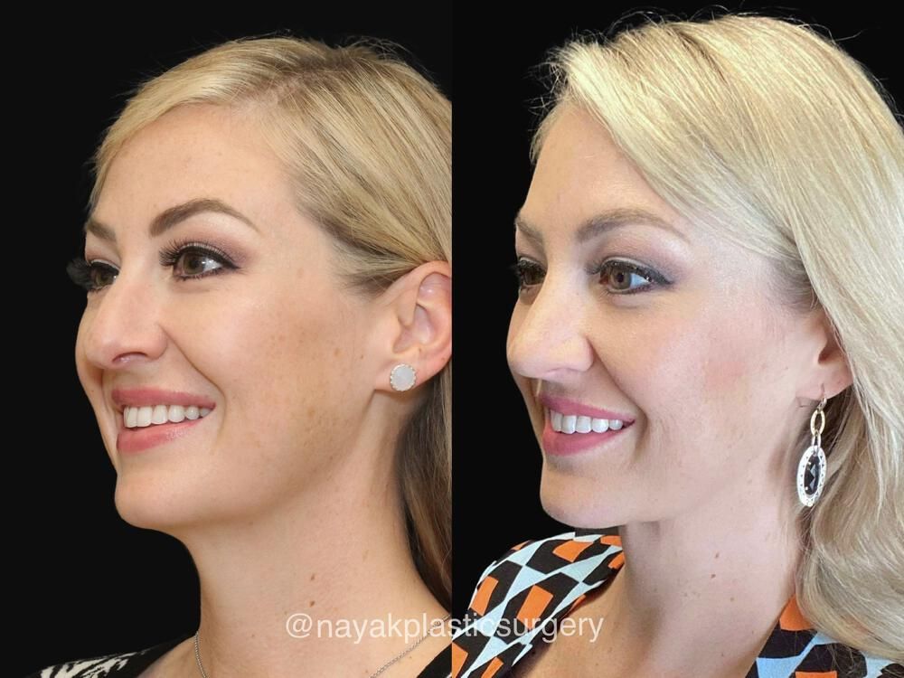 Deep Necklift Before & After