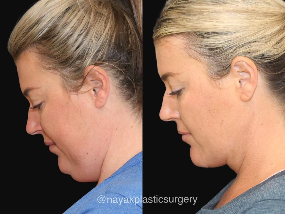Deep Necklift Before & After