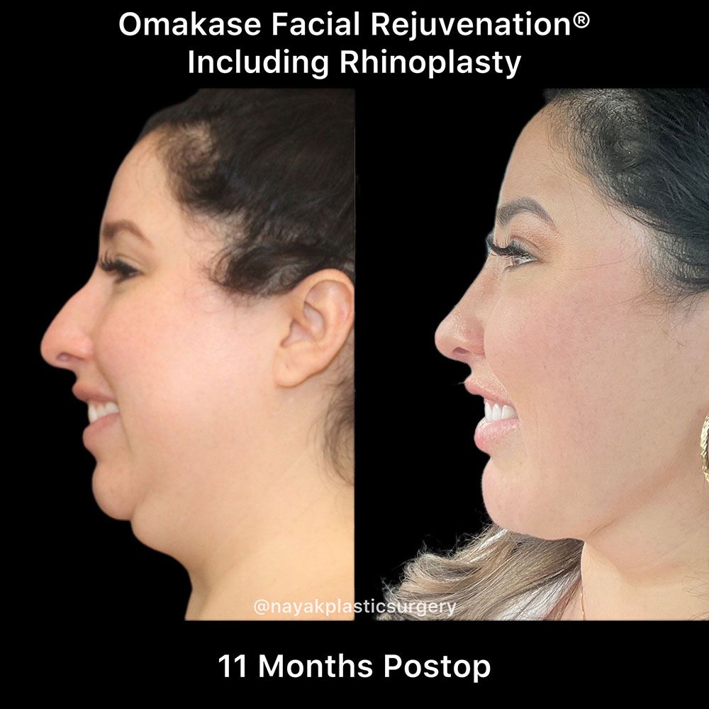 Deep Necklift Before & After