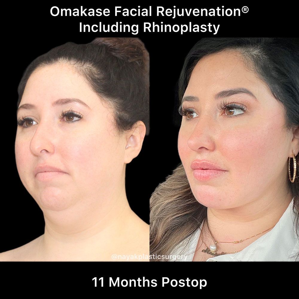 Deep Necklift Before & After