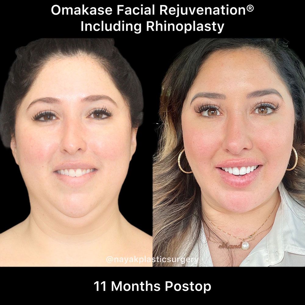 Deep Necklift Before & After