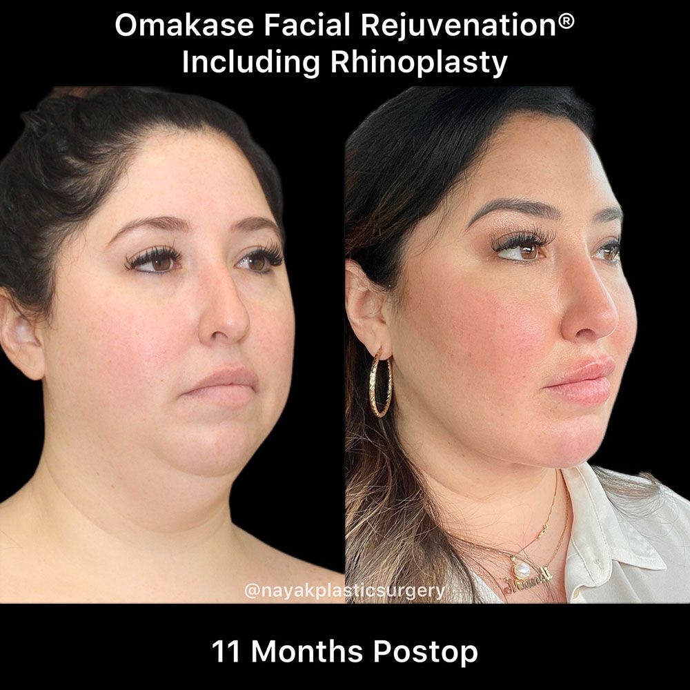 Deep Necklift Before & After