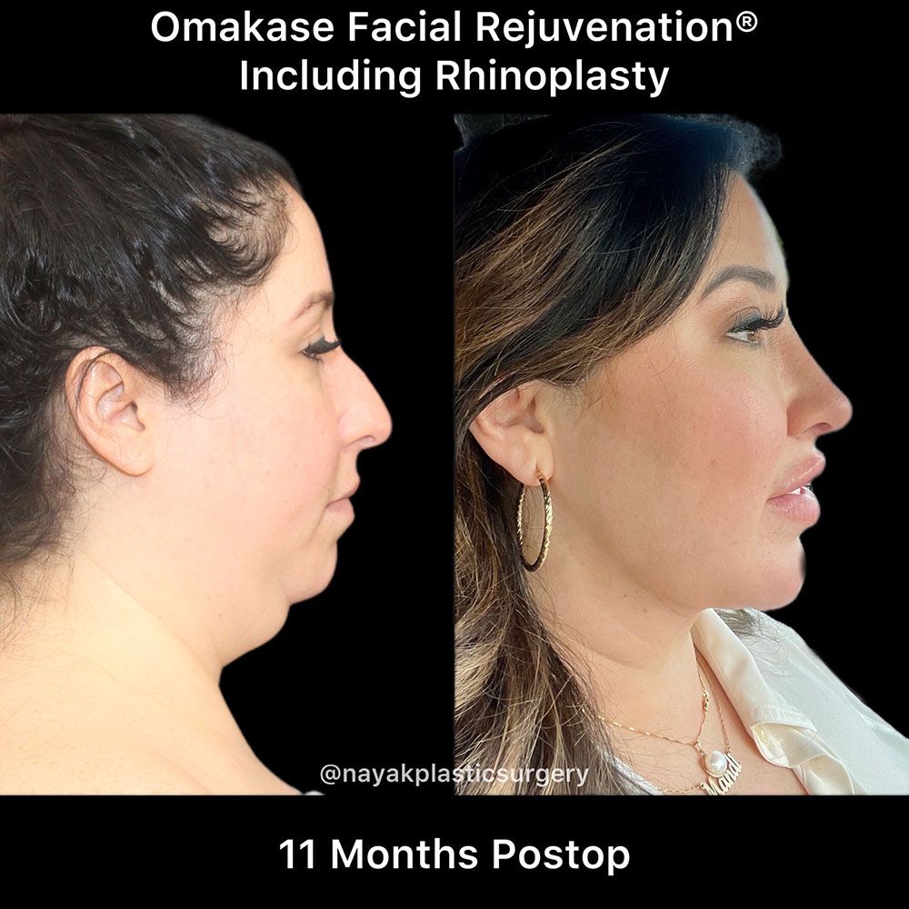 Deep Necklift Before & After