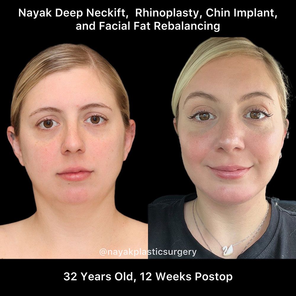 Deep Necklift Before & After