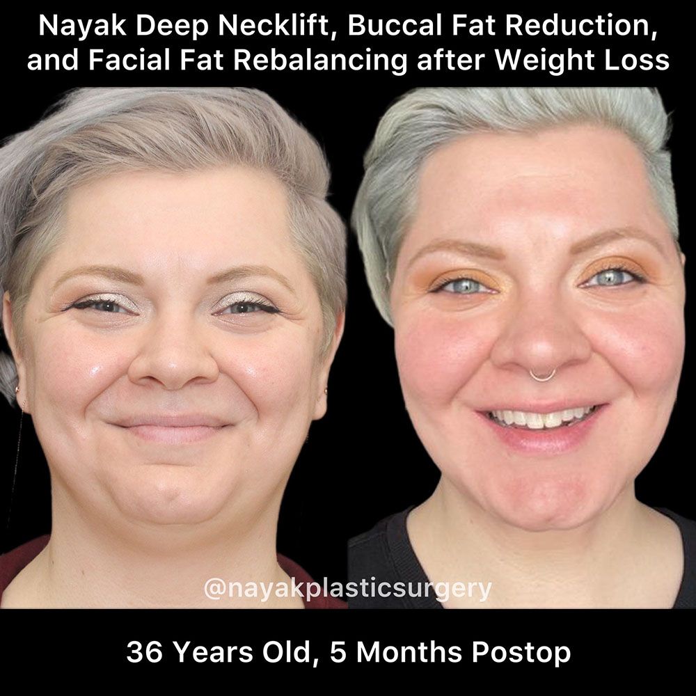 Deep Necklift Before & After
