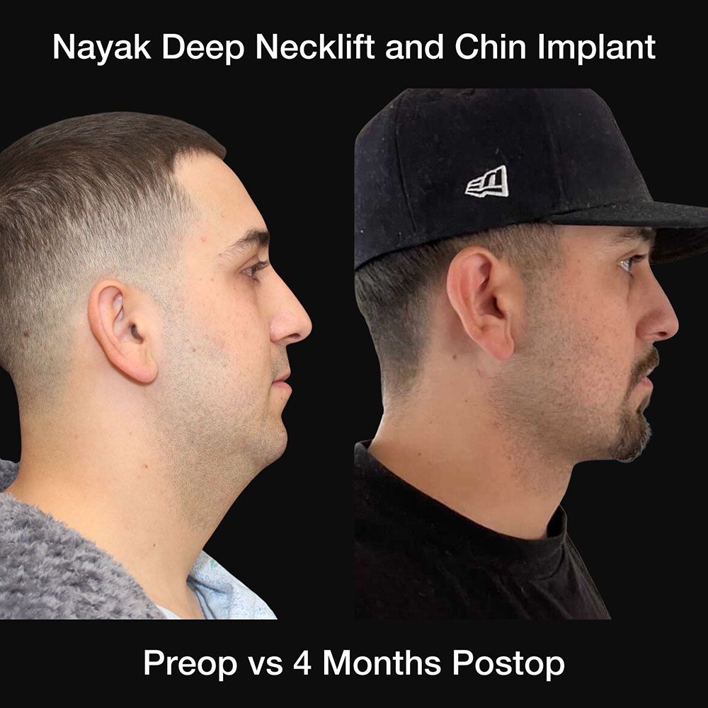 Deep Necklift Before & After