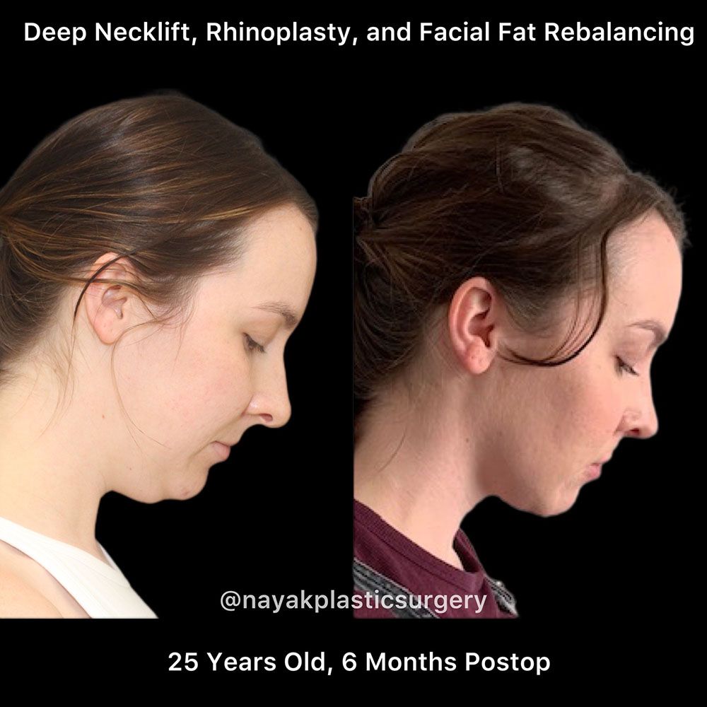 Deep Necklift Before & After
