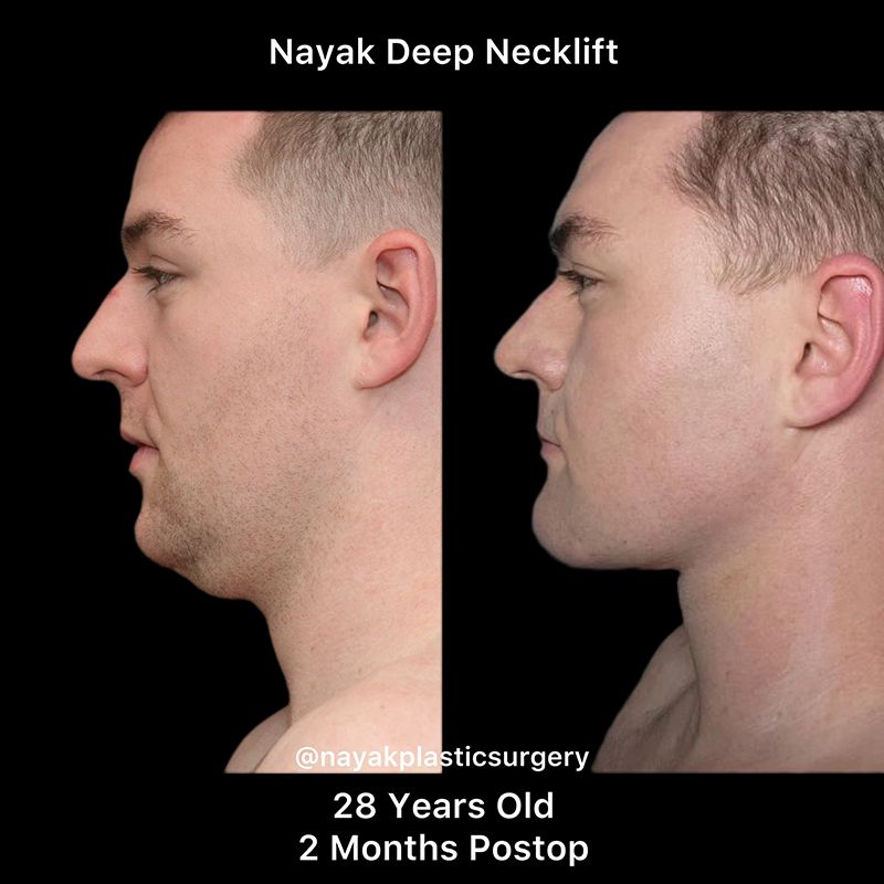 Deep Necklift Before & After