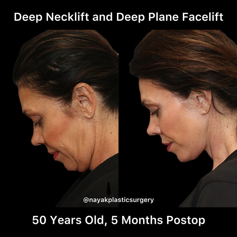 Deep Necklift Before & After