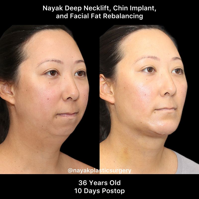 Deep Necklift Before & After