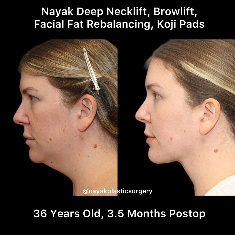 Deep Necklift Before & After