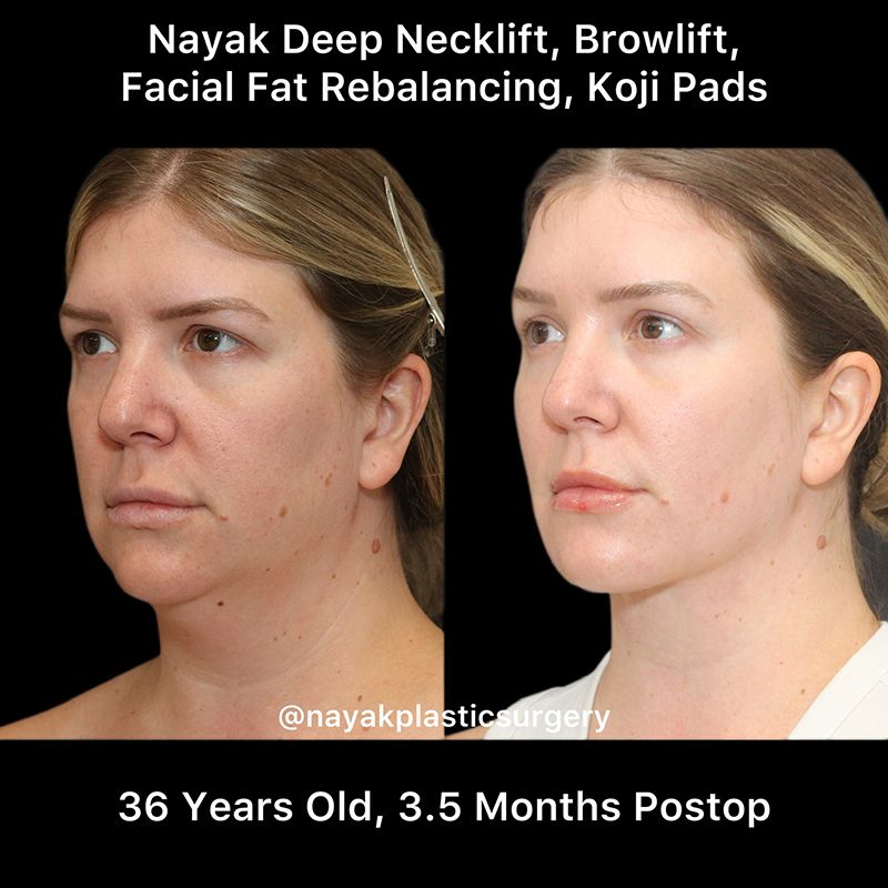 Deep Necklift Before & After