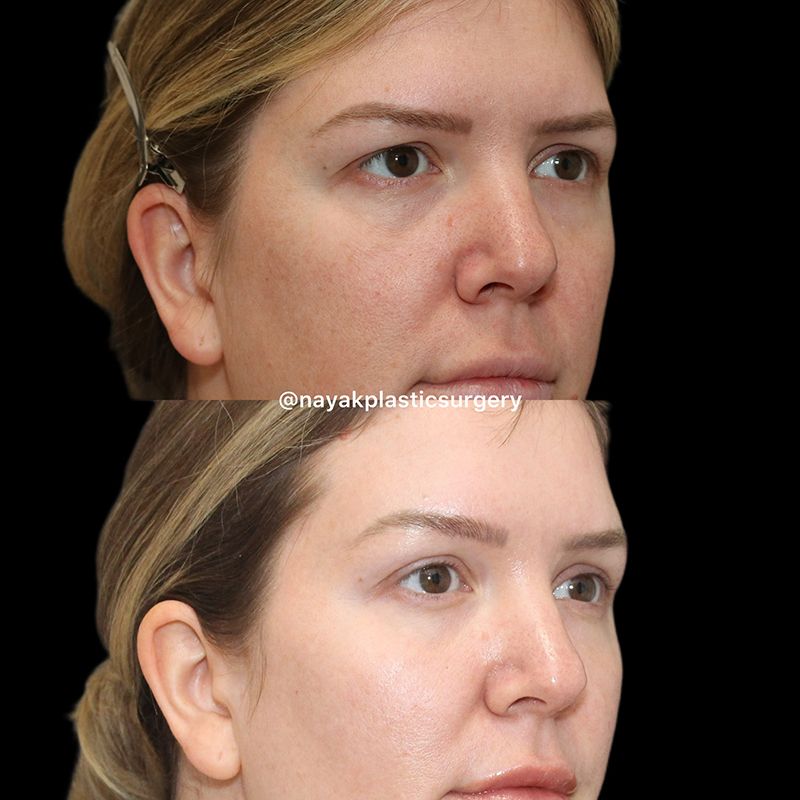 Deep Necklift Before & After