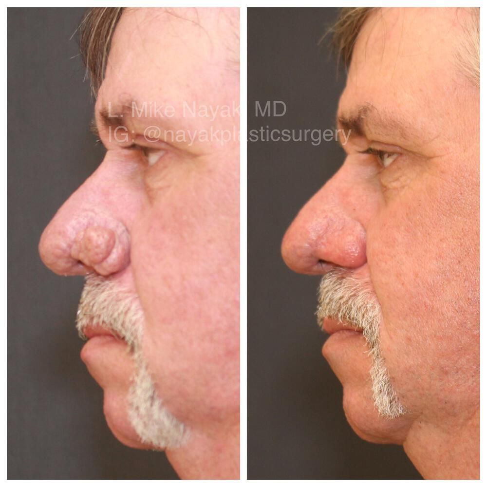Rhinophyma Reduction Before & After