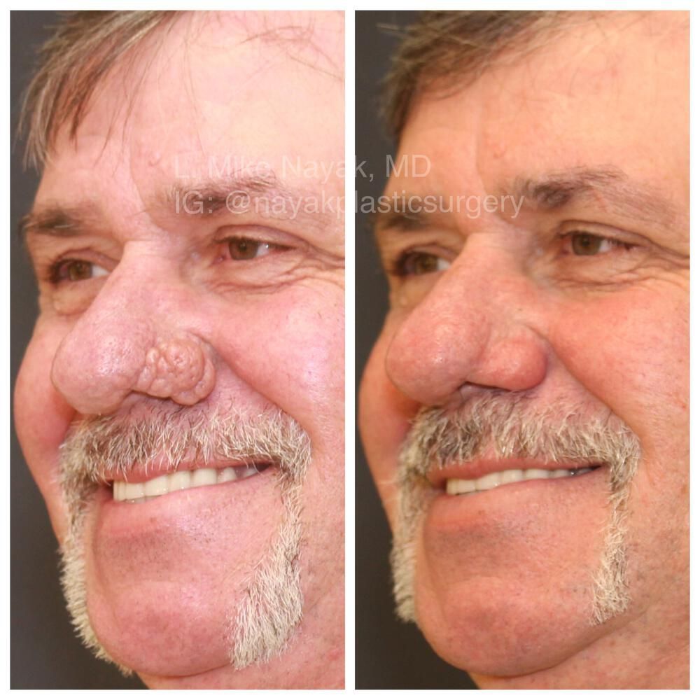 Rhinophyma Reduction Before & After