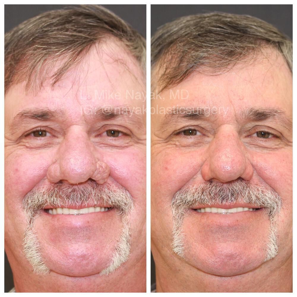 Rhinophyma Reduction Before & After