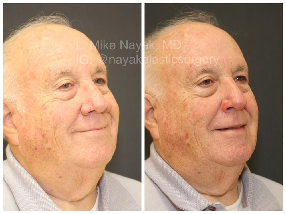 Rhinophyma Reduction Before & After
