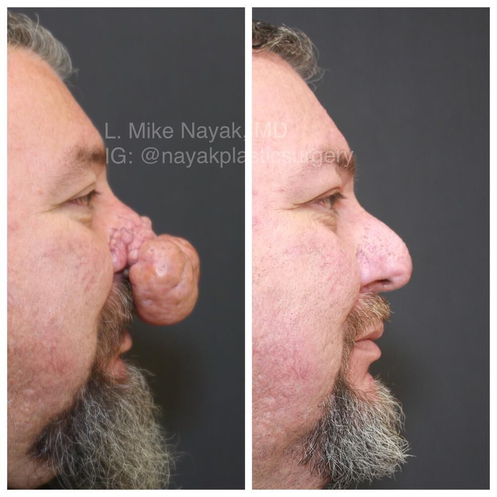 Rhinophyma Reduction Before & After
